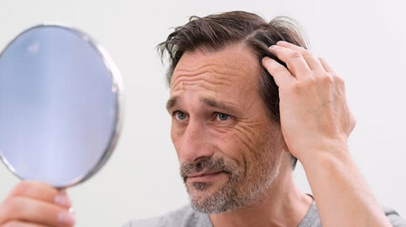 Alopecia: tipos e causas, há esperança?